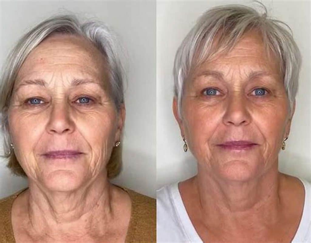 Vorher und nachher &ndash; Ergebnis von Sigrid W., 66